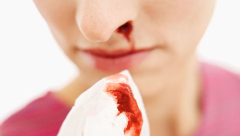 home remedies for nosebleeds_new_love_times