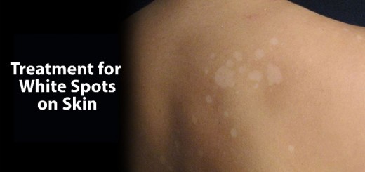 how to get rid of white spots on skin_new_love_times