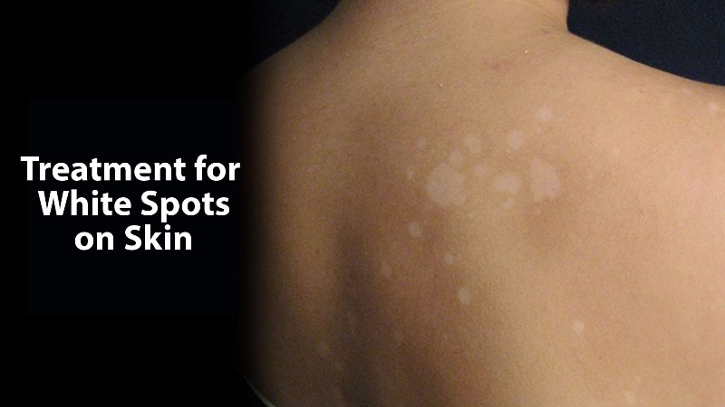 how to get rid of white spots on skin_new_love_times