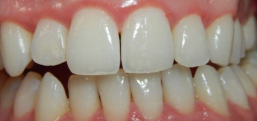 home remedies for receding gums_new_love_times