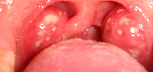 home remedies for tonsillitis_new_love_times