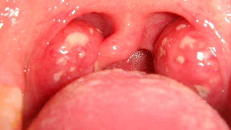 Tonsilitis Throat 89
