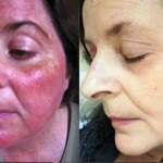 8 Home Remedies That Will Help You Treat Rosacea