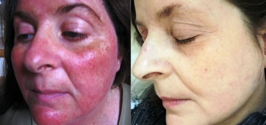 home remedies for rosacea_New_Love_Times