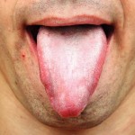 10 Amazingly Effective Natural Home Remedies For White Tongue