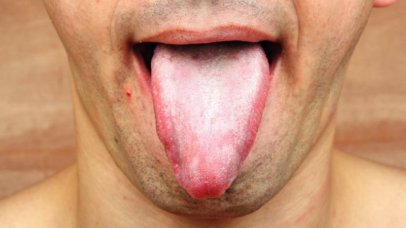 home remedies for white tongue_new_love_times