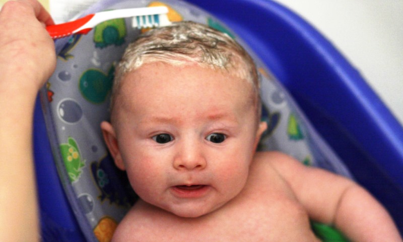 Home remedies for cradle cap_New_Love_Times