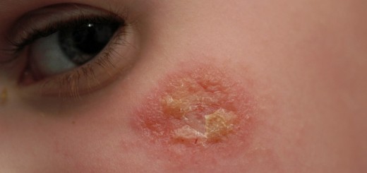 Home remedies for eczema on face_New_Love_Times