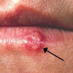 13 Miraculous Home Remedies For Herpes Which Work Like Magic