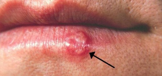 home remedies for herpes_new_love_times