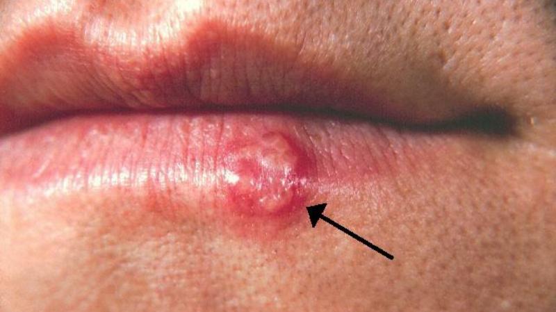 home remedies for herpes_new_love_times