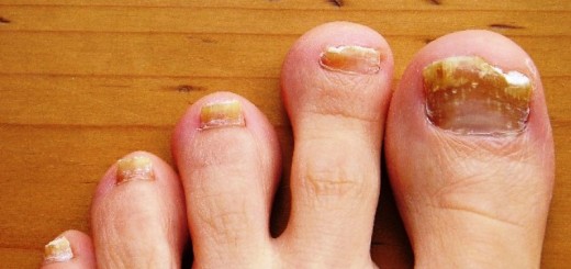 home remedies for toe fungus_New_Love_Times