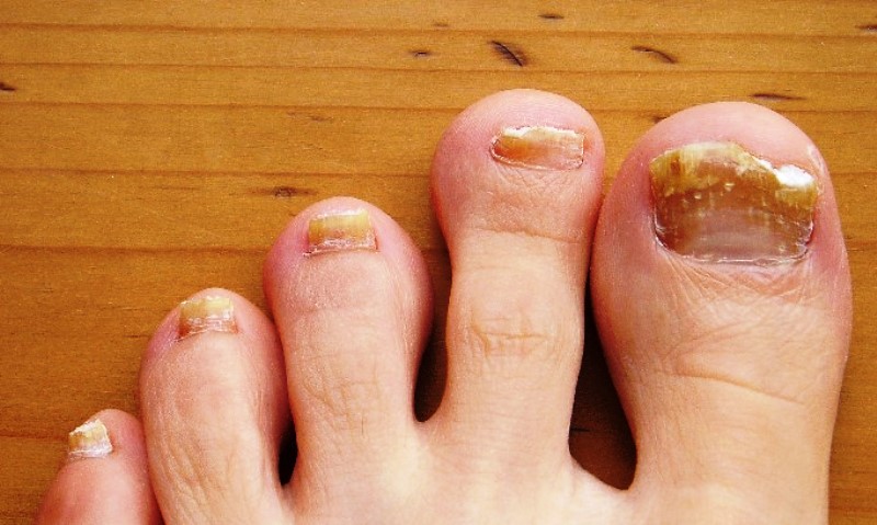 home remedies for toe fungus_New_Love_Times 