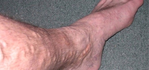 home remedies for varicose veins_new_love_times
