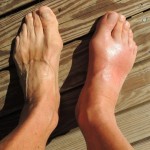 12 Natural And Effective Home Remedies For Gout Pain