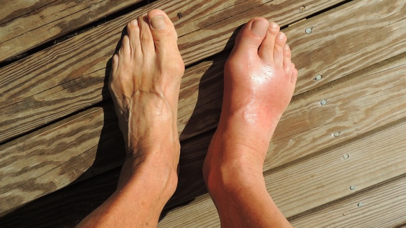 home remedies for gout pain_new_love_times