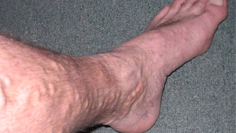 home remedies for varicose veins_new_love_times