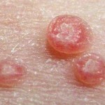 8 Most Effective Home Remedies for Molluscum Contagiosum