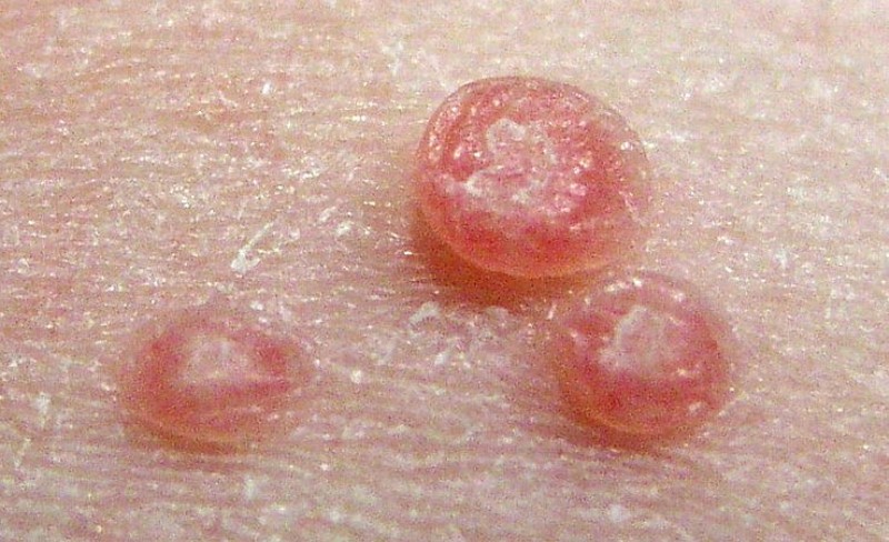 home remedies for Molluscum contagiosum_New_Love_Times