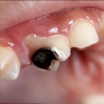 13 All-Natural Home Remedies For Cavity And Tooth Decay That Actually Work!