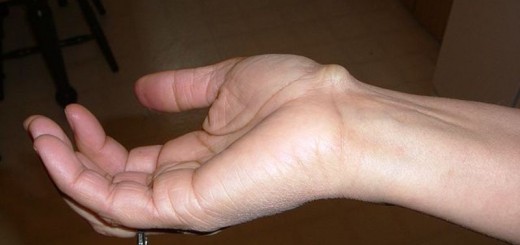 home remedies for ganglion cysts_new_love_times