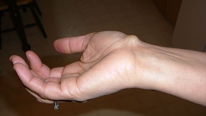 Ganglion home cyst wrist remedies for on 22 Effective