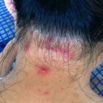 Top 9 Home Remedies for Folliculitis