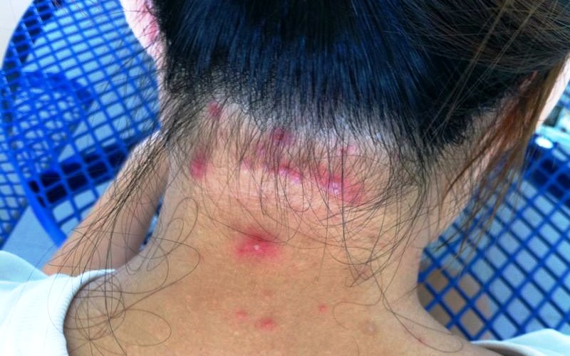 Home remedies for Folliculitis_New_Love_Times