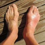 8 Best Home Remedies for Bunions