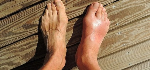 Home remedies for bunions_New_Love_Times