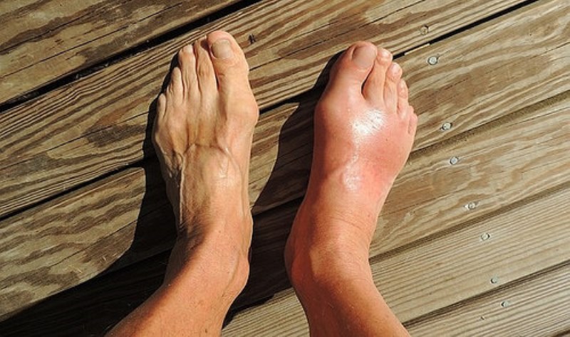 Home remedies for bunions_New_Love_Times