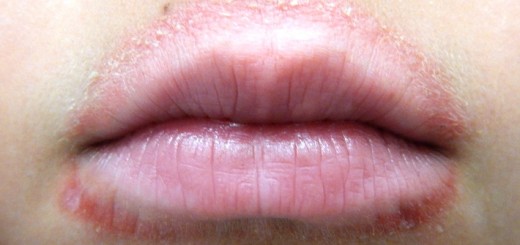 home remedies for perioral dermatitis_New_Love_Times