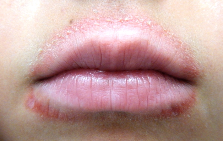 Dermatitis vinegar perioral treatment Perioral Dermatitis: